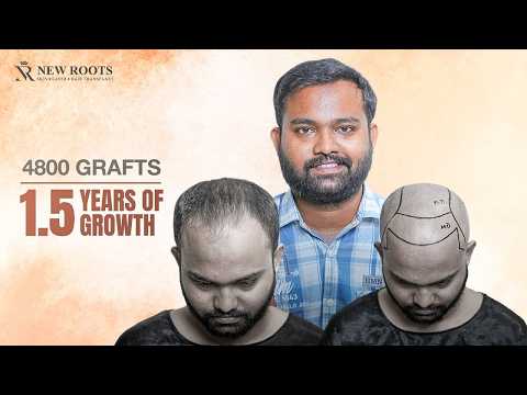 From Hiding My Hair to Loving It 🔥 | Hair Transplant in Kolkata | New Roots | Bengali