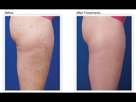 Vidéo: Éliminer La Cellulite : Une Approche Globale