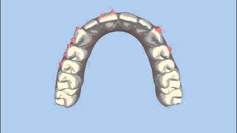 Invisalign treatment simulation clincheck for Faye (upper teeth)