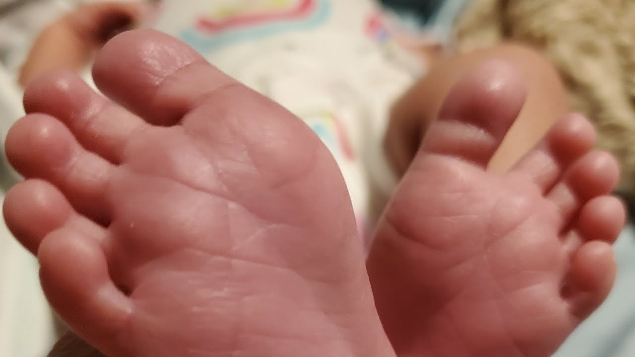 CLASSICAL C-SECTION  3 WEEKS POST OP