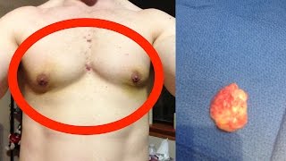 Gyno surgery - am I just fat or do I have gynecomastia?