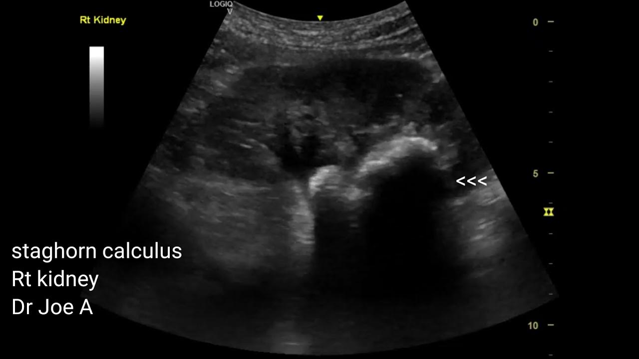 large-staghorn-calculus-right-kidney-ultrasound-video-mild-obstruction