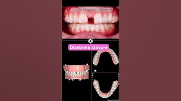 MARPE diastema closure with Shape Memory Aligners