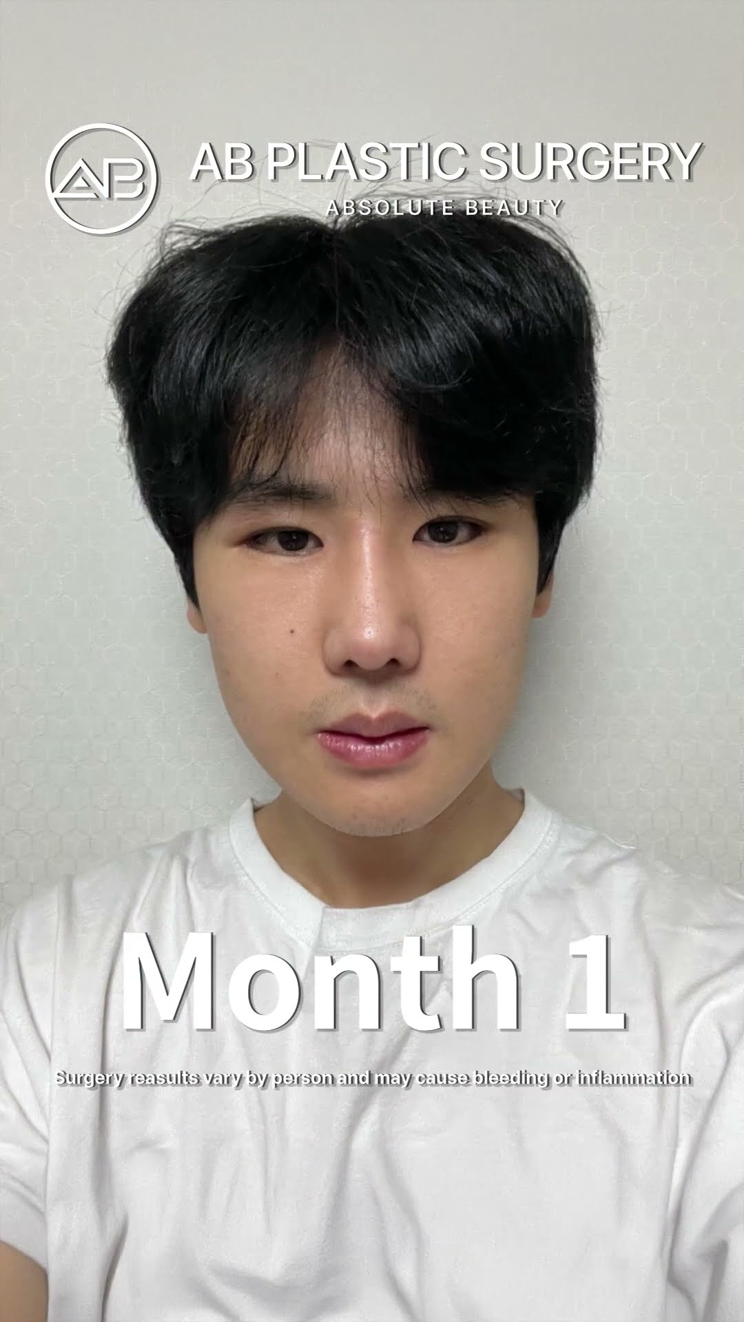 Plastic Surgery Transformed His Life Unbelievable Before & After #shorts