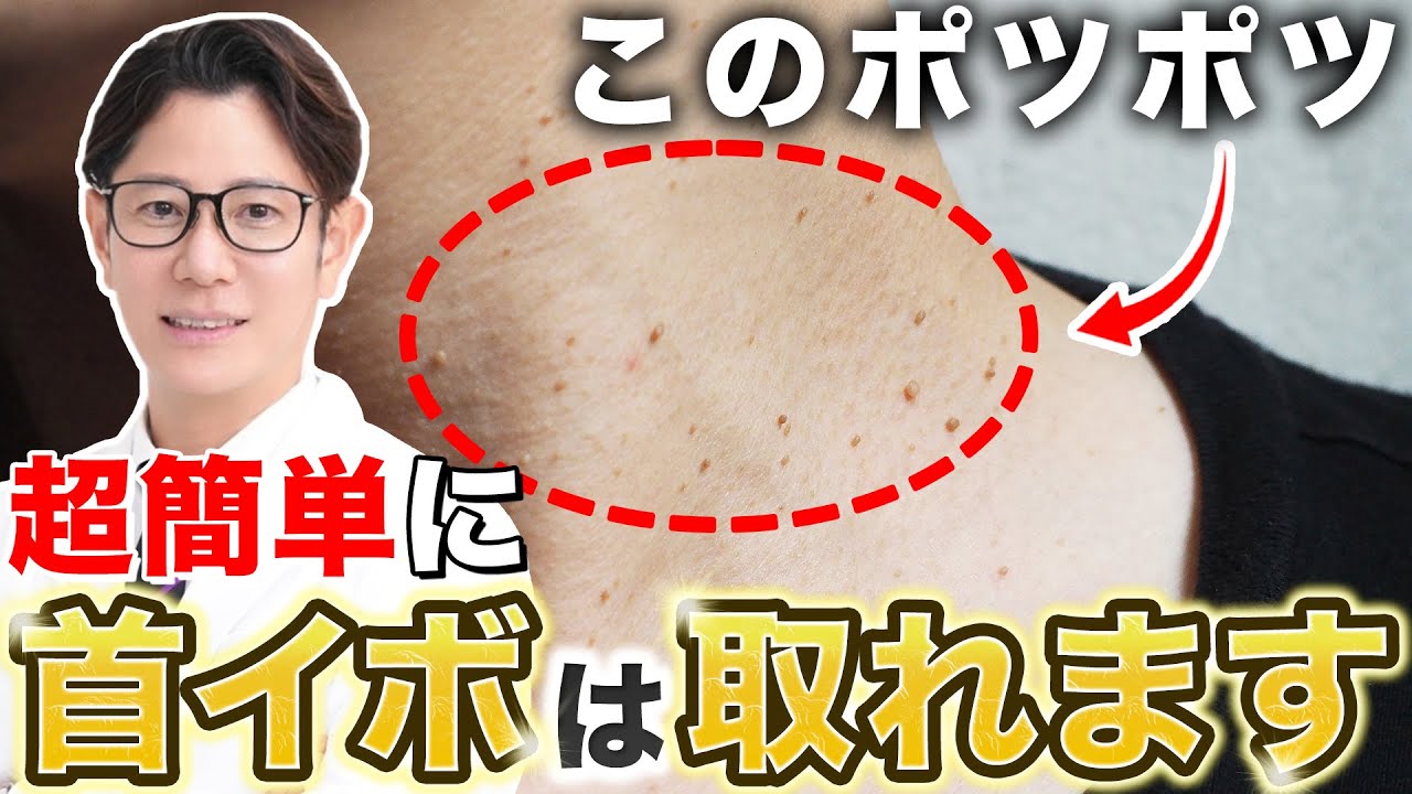 首のイボを簡単に取る方法を解説