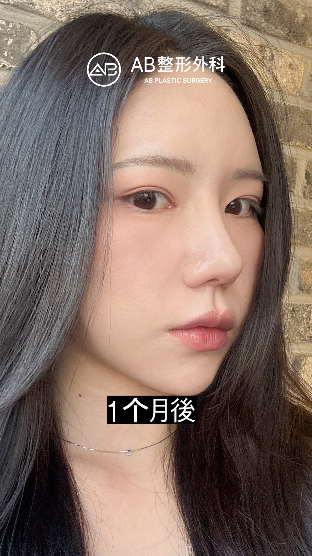 韓式隆鼻1個月後變化！變成自然翹鼻女神 #shorts