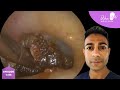 1,135 - Sticky Ear Wax Removal off Eardrum