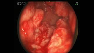 Multimodal treatment of GAVE syndrome