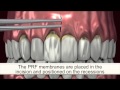 Painless Gum Recession Treatment | (310) 299-8329 | RejuvaGum Lift | Los Angeles Periodontist