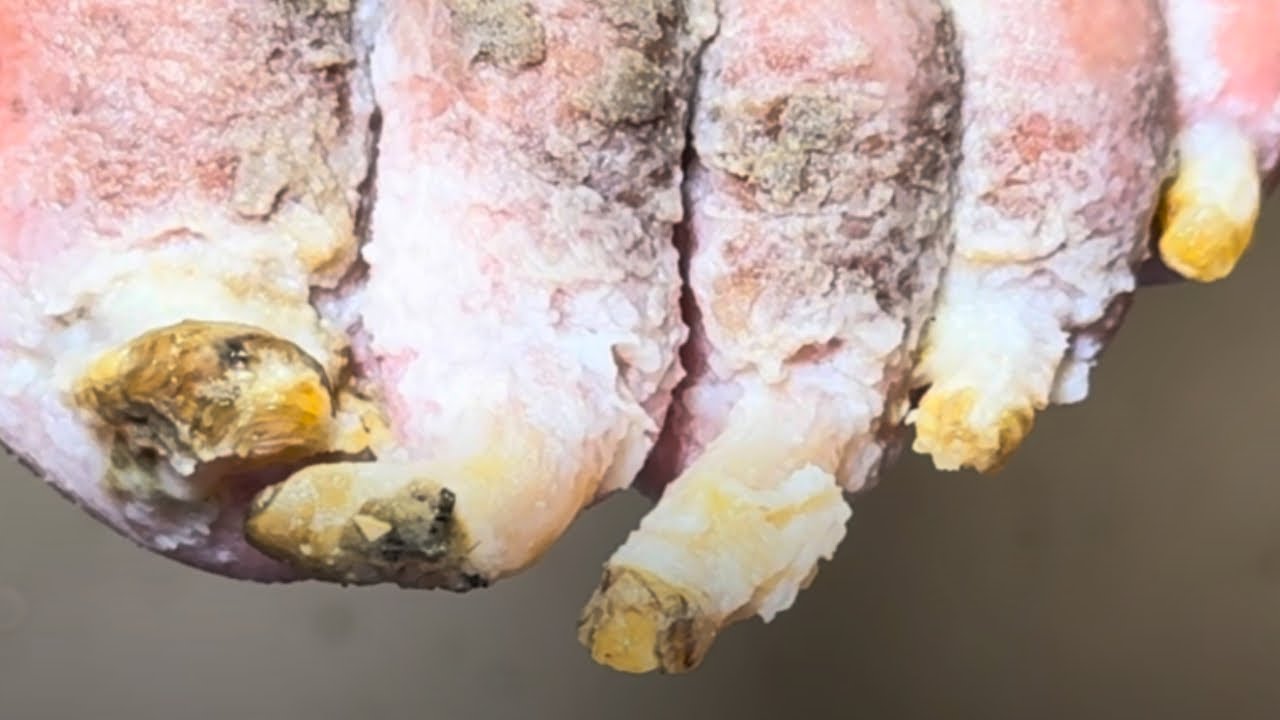 Clean Your Feet And Remove Black Dead Skin Bit By Bit【Podiatry Clinic】