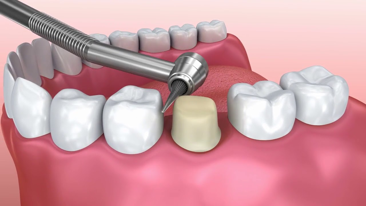 Crown Treatments - Ipswich Dental Surgery
