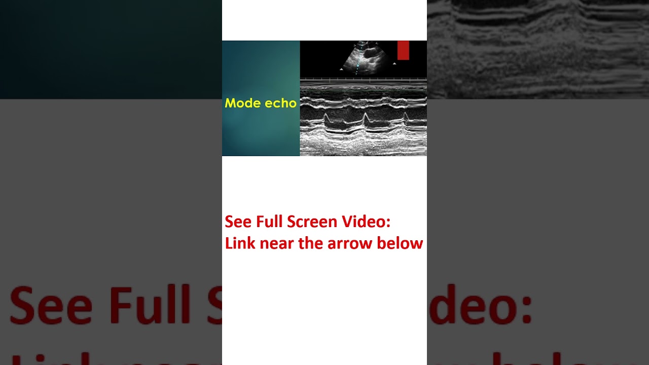 Normal Color Doppler Echocardiogram