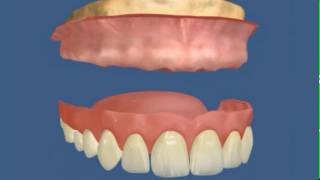 Teljes Felső Kivehető Műfogsor - Mindentment Fogászat