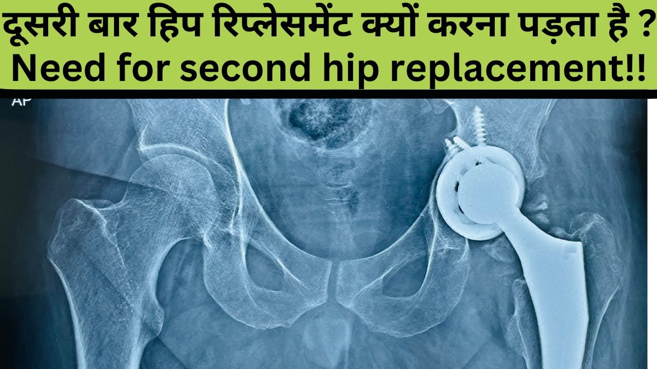 Is There NEED For SECOND Hip Replacement In The Same Hip LIVE Q A With is-there-need-for-second-hip-replacement-in-the-same-hip-live-q-a-with
