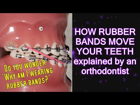 How elastics rubber bands move teeth time lapse Braces Explained