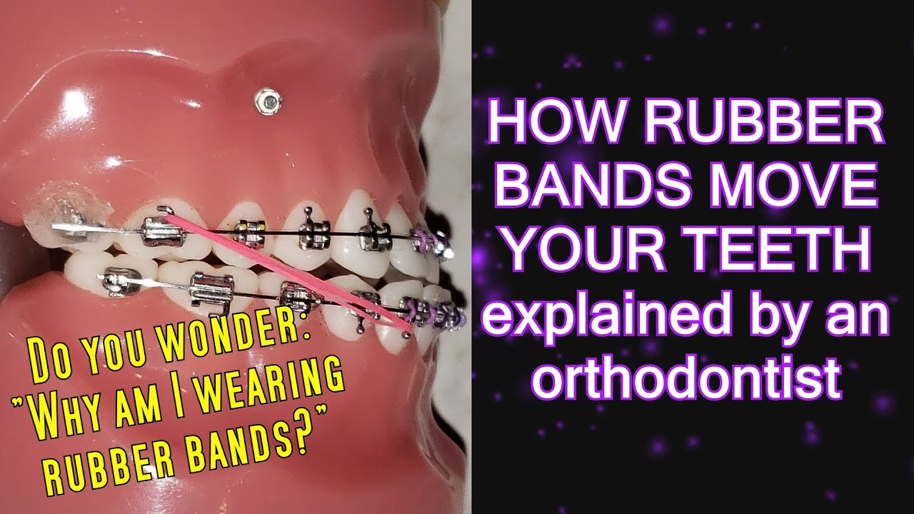 How elastics / rubber bands move teeth (time lapse) - Braces