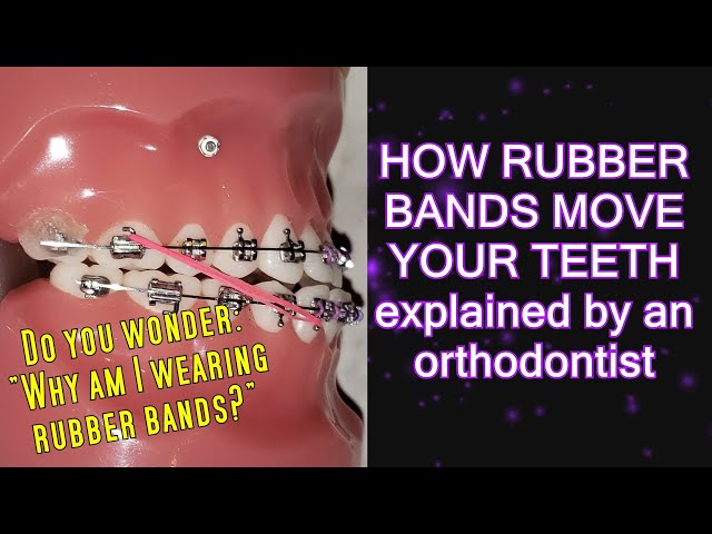 How elastics / rubber bands move teeth (time lapse) - Braces Explained! 