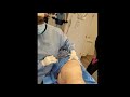 Liposuction revision VASER and Renuvion skin tightening. Had tummy tuck and lipo 360 done elsewhere