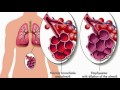 Download Asthma And Bronchitis  - Pdf Free