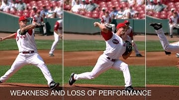 Multidirectional Shoulder Instability