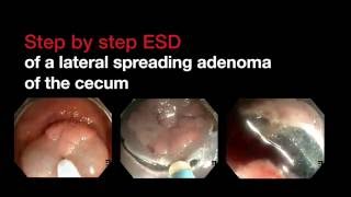 Step by step ESD at the cecum