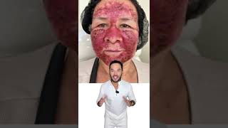 Queratosis actínica Queratosis actínica