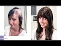 Female Hair Loss Solution - Mark Glenn Hair Enhancement, London