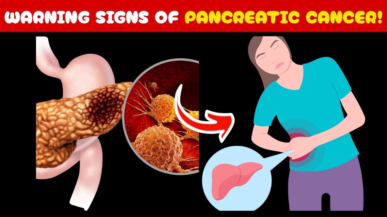 Signs and Symptoms of Pancreatic Cancer Explained | Know the Warning ...