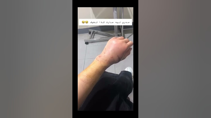 شوفو وش صار بيدي لما عضني القط 💔