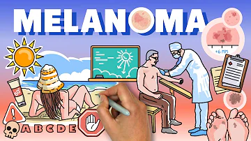 ¿Qué aspecto tienen los primeros signos de melanoma?