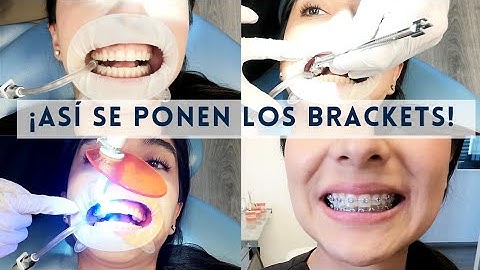 ¿CÓMO SE PONEN LOS BRACKETS? TE MUESTRO EL PASO A PASO #brackets #viral