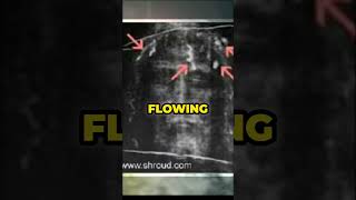 10. Crown of Thorns - Clearly Seen on the Shroud. Shroud of Turin Part 10.