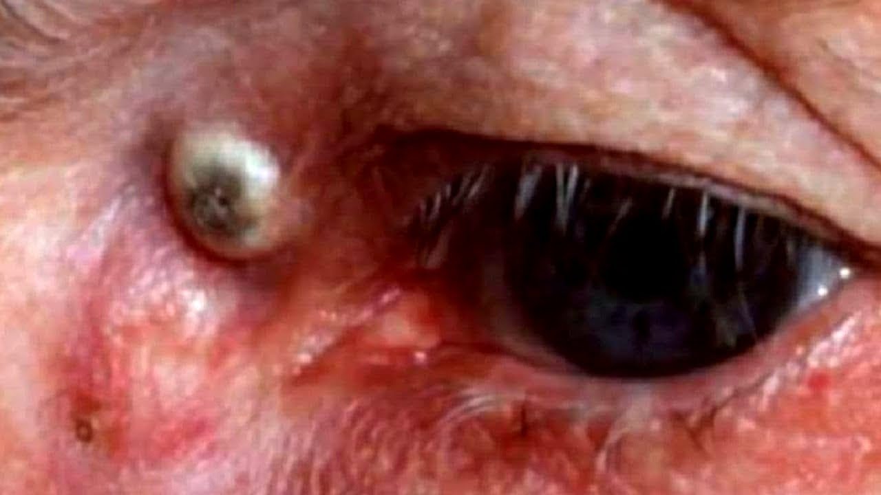 blackhead Acne treatment & Blackheads popping #33