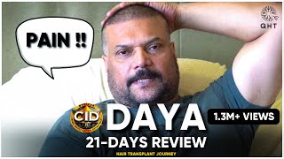 FUE Hair Transplant Results | DAYA's FUE Hair Transplant Results - Actor's Honest Experience | Hair