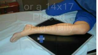 Tib Fib Lateral.wmv