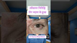 आँखामा भिरिङ्गि रोग syphilis youn रोग नेपालीमा tpha vdrl test in nepal