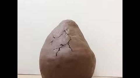 "Birth Unexplained" -iMotion Video