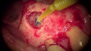 #20 Apicoectomy