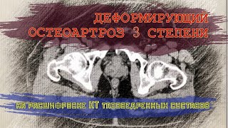 Деформирующий ОСТЕОАРТРОЗ ТАЗОБЕДРЕННОГО СУСТАВА 3 степени и ИМПИДЖМЕНТ синдром на РАСШИФРОВКЕ КТ