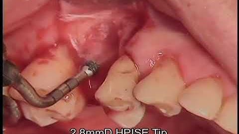 Ridge Augmentation using Decalcified Autologous Tooth Block and Powder Bone