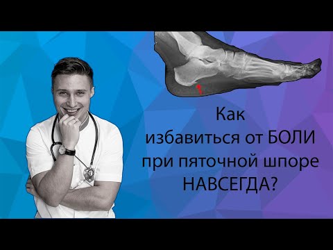 Как избавиться НАВСЕГДА от БОЛИ при ПЯТОЧНОЙ ШПОРЕ: народное средство