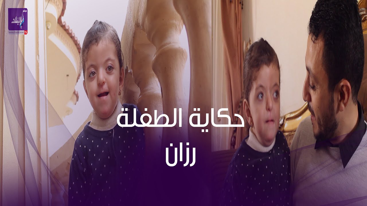 حكاية الطفلة رزان مع متلازمة ابرت .. ووالدها : راضي بقضاء الله