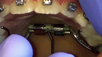 Orthodontic Expander Turning Video