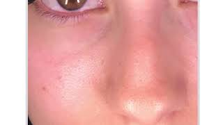 Removing redness from your clients eyes after their lash extension appointment