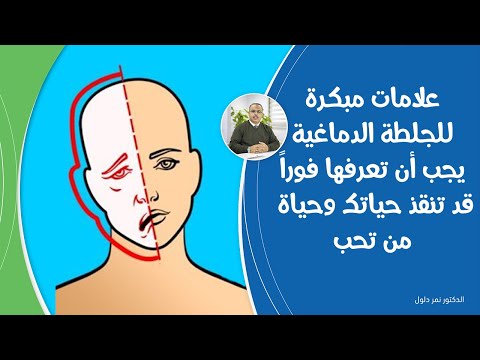 فيديو: 5 طرق لاستخدام نقاط العلاج بالابر للصداع النصفي