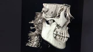 Square jaw surgery