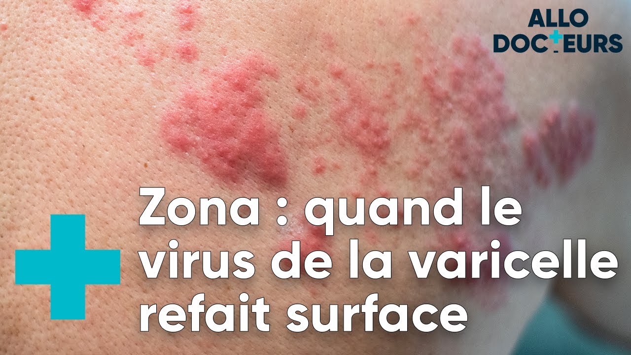 Toutes vos questions sur le zona - Allo Docteurs