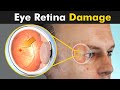 Retinitis Pigmentosa : Damage To Retina Of The Eye | Symptoms, Causes And Treatment