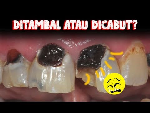 pijat #terapi #akupresure Cara mudah mengatasi sakit gigi tanpa obat. Dengan pijat Terapi akupresure. 