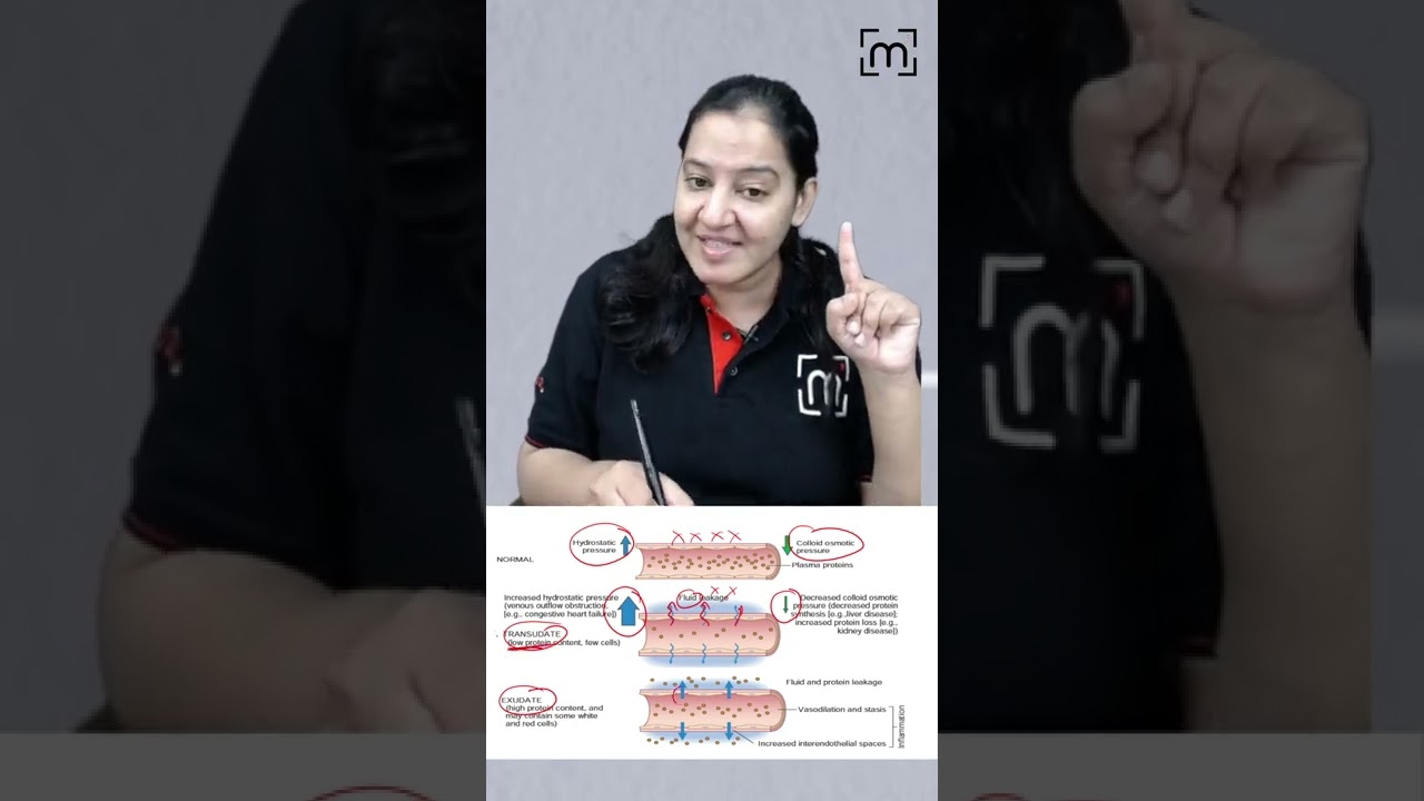 1 minute learning: Types of Oedema - Transudate and Exudate | MedLive | Dr. Priyanka Sachdev